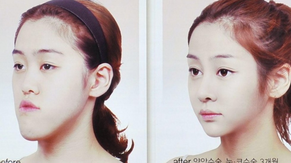 Risky Double Jaw Surgery South Koreas Latest Cosmetic Fad South 