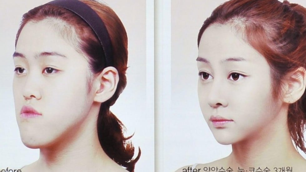 Risky Double jaw Surgery South Korea s Latest Cosmetic Fad South risky-double-jaw-surgery-south-korea-s-latest-cosmetic-fad-south