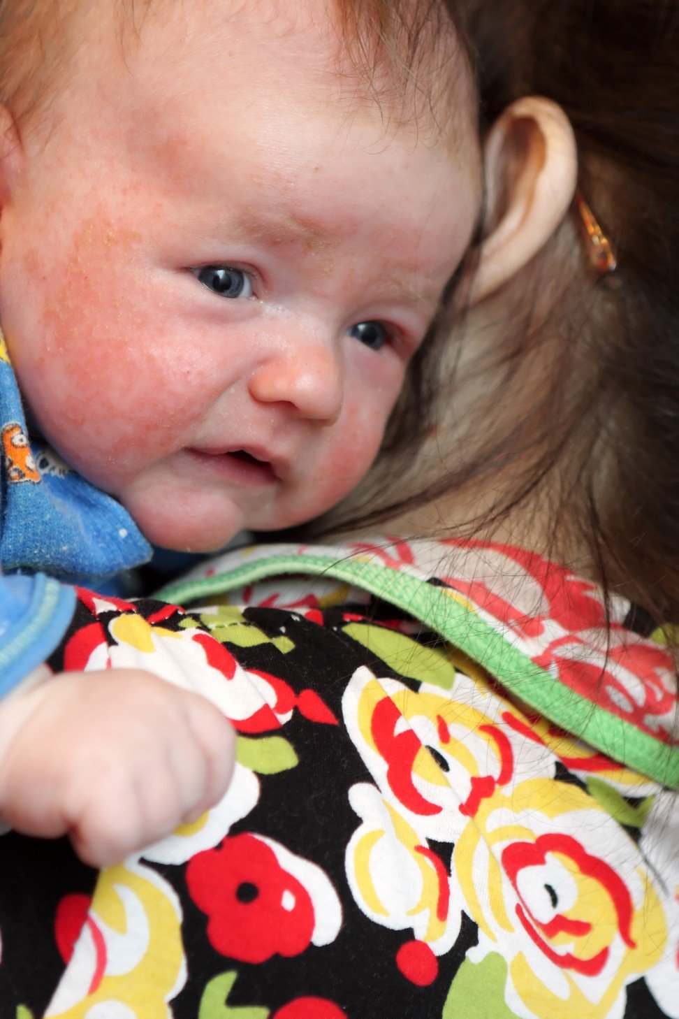 A baby suffering from eczema.