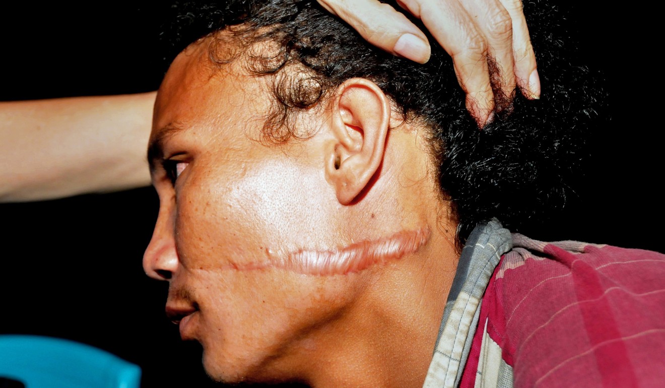 In this photograph released by Indonesia's Ministry of Fishery in 2015, an unidentified foreign fisherman is seen with a big scar on his face after being rescued by Indonesia's illegal fishing task force on Benjina island. Photo: AFP