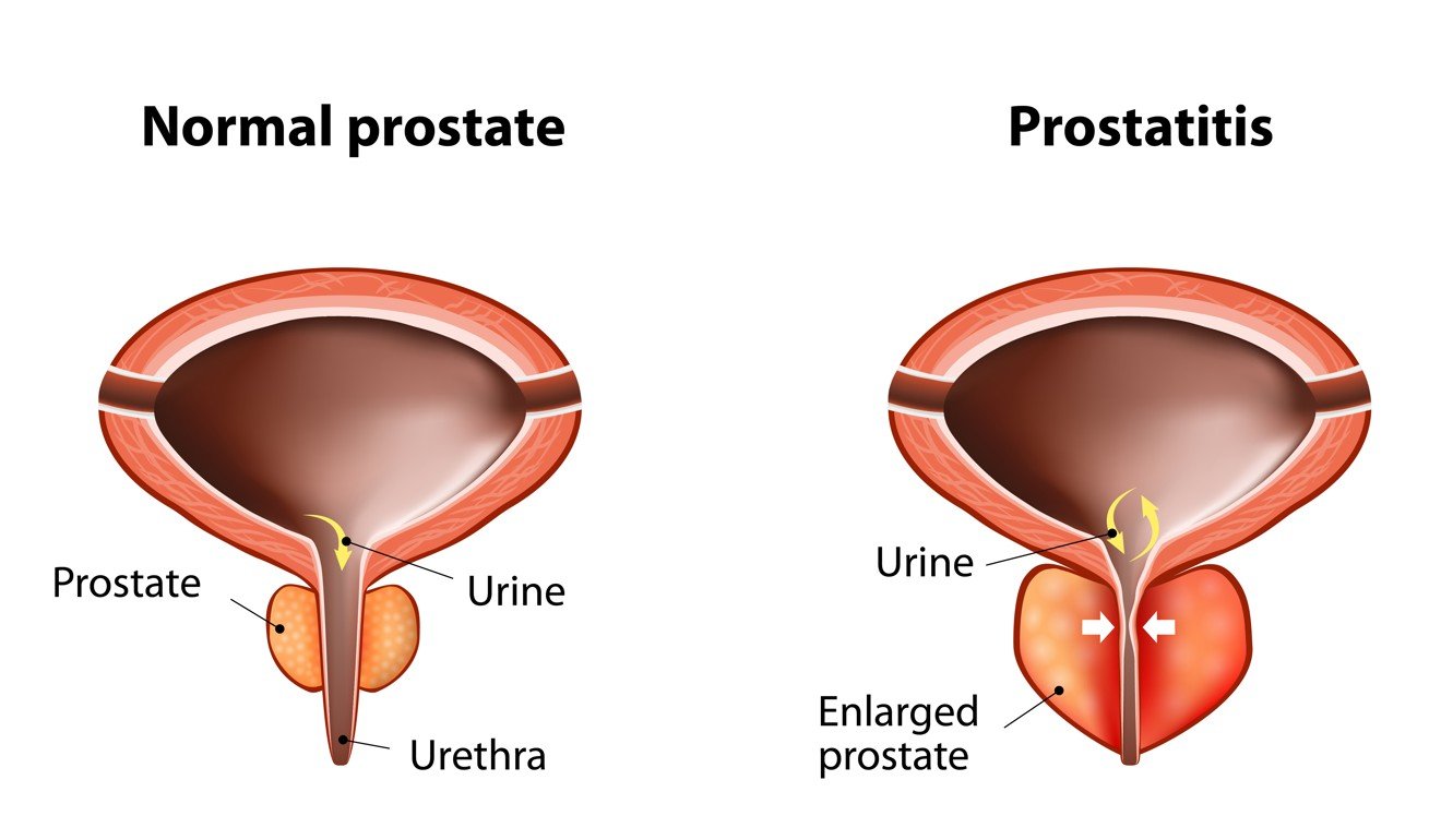 Prostate cancer. Image: Shutterstock