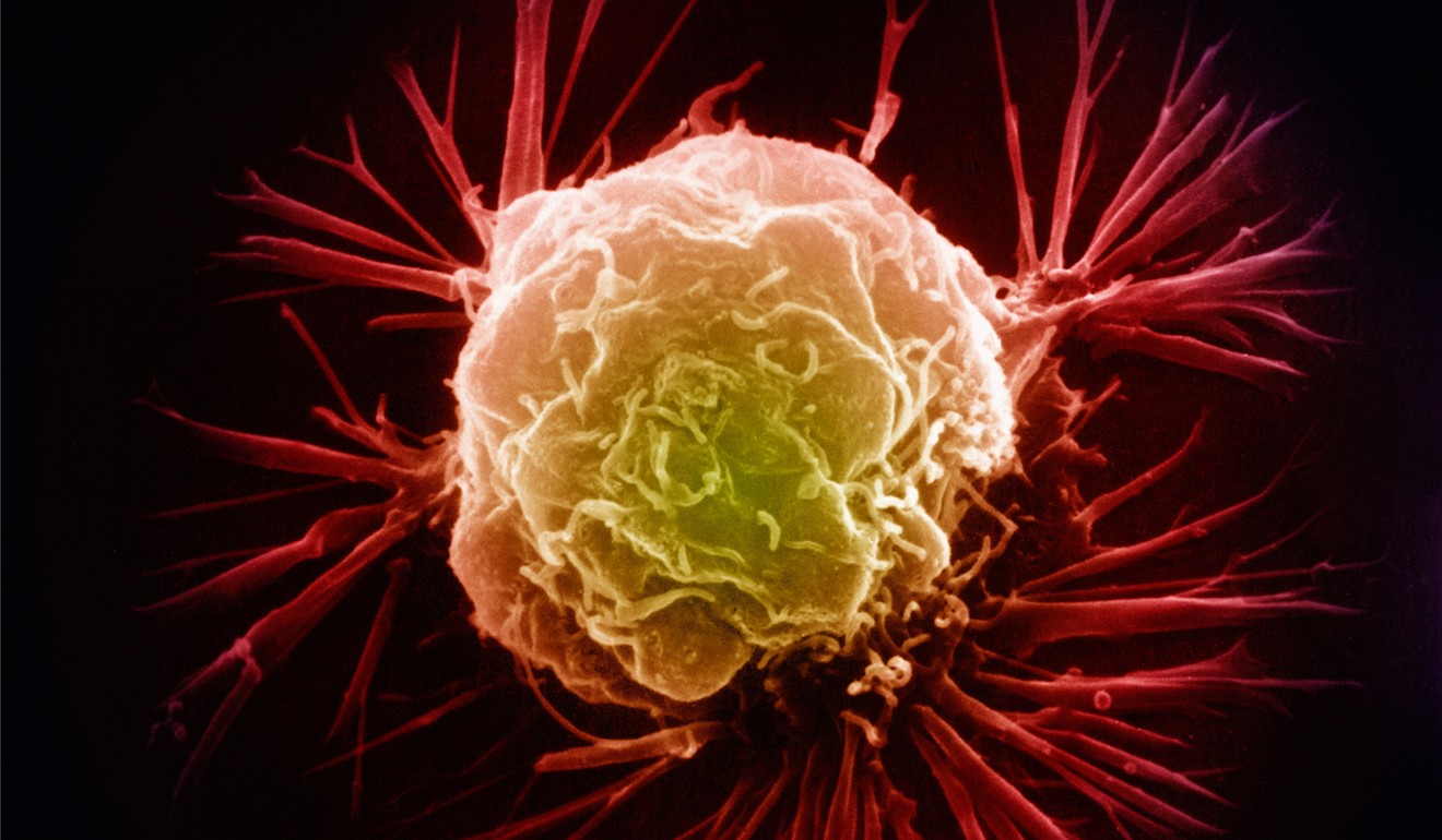 Scanning electron micrograph of a breast cancer cell. Photo: Alamy